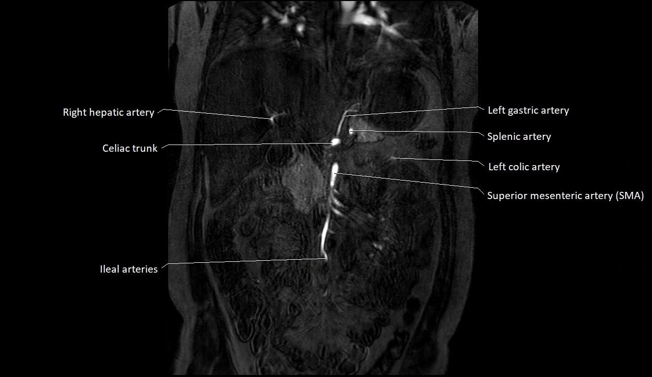 MRA Abdomen coronal anatomy image 9.webp
